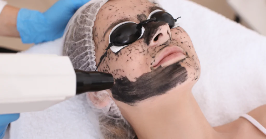 Women receiving Carbon Laser Peel in Plantation, FL