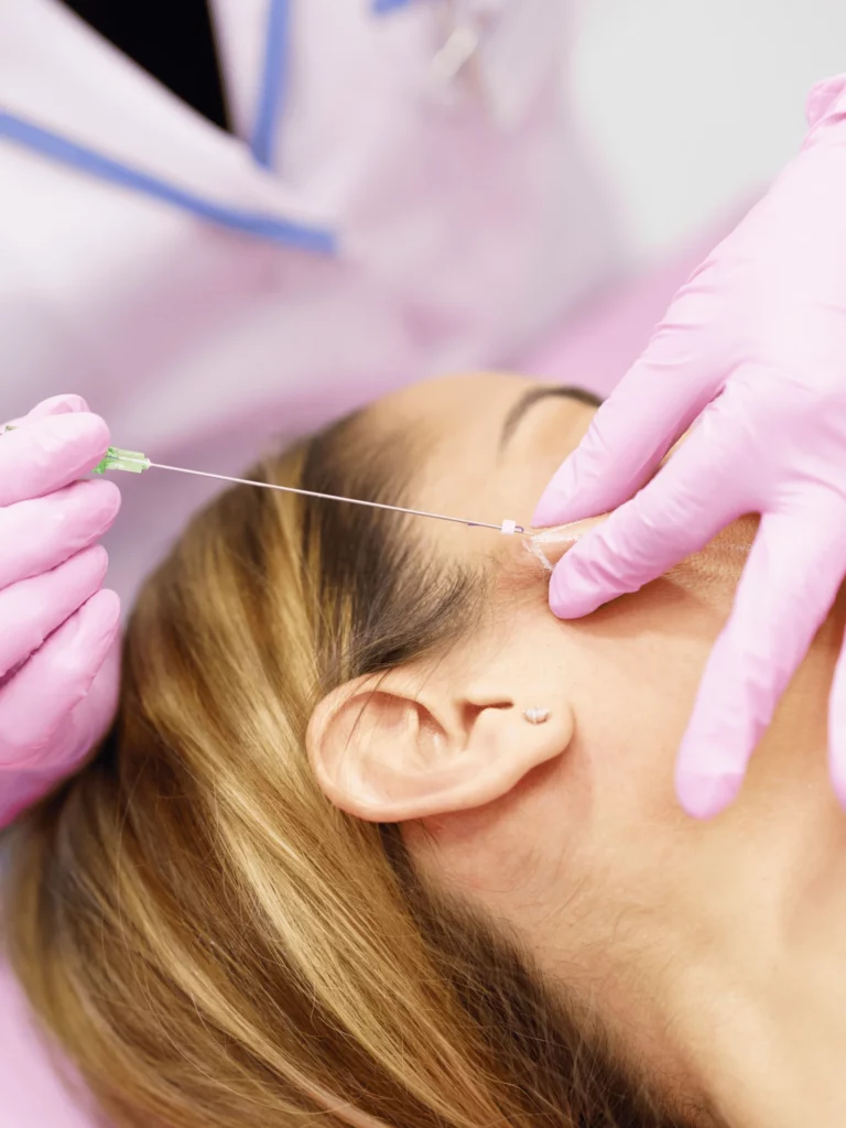 PDO Threads in Plantation FL by Maven Aesthetics