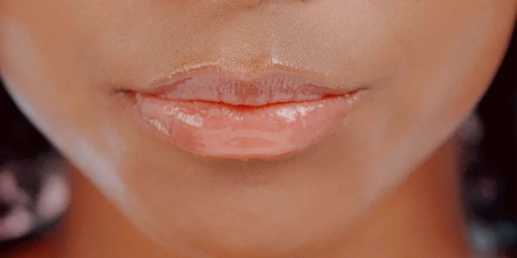 Lip Augmentation with Dermal Fillers in Plantation FL by Maven Aesthetics