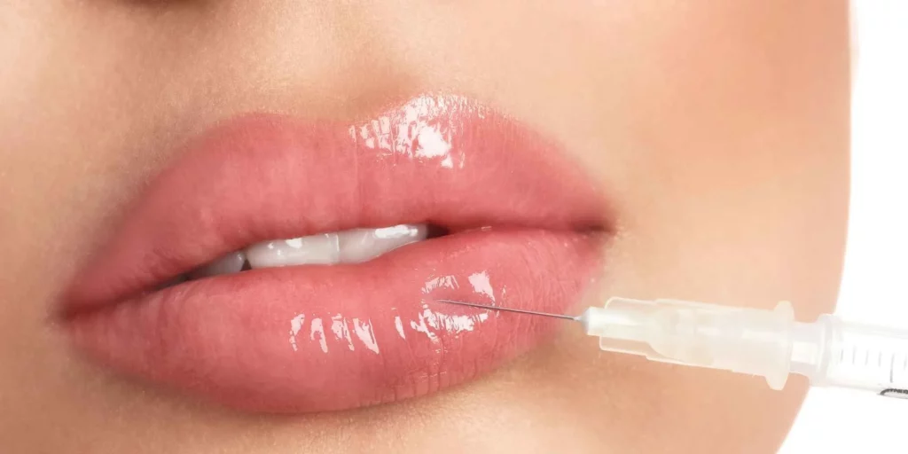 Lip Augmentation with Dermal Fillers in Plantation FL by Maven Aesthetics