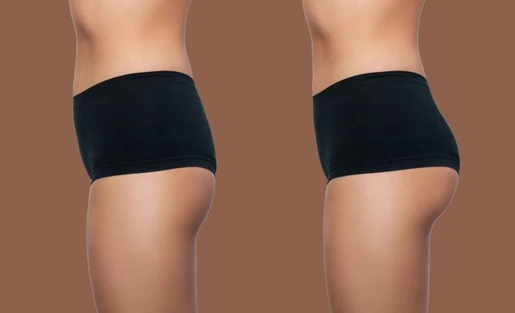 Brazilian Butt Lift in Plantation FL by Maven Aesthetics