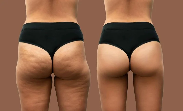 Brazilian Butt Lift in Plantation FL by Maven Aesthetics