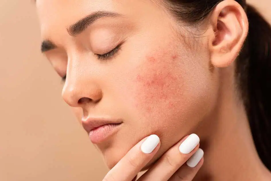 Acne treatments in Plantation, FL by Maven Aesthetics Studio