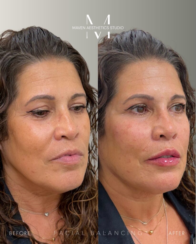Angled three-quarter before and after photo showing subtle facial harmonization and lower-face support at Maven Aesthetics Studio