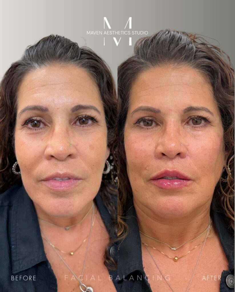 Before and after front view of a facial balancing patient at Maven Aesthetics Studio in Plantation, FL showing natural, refreshed facial proportions